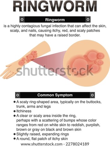 Informative symptoms of Ringworm illustration
