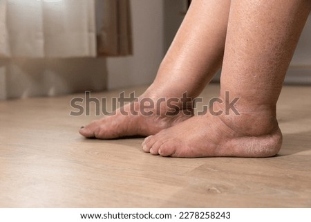 Woman's leg is edema (swelling) after cancer treatment. Royalty-Free Stock Photo #2278258243