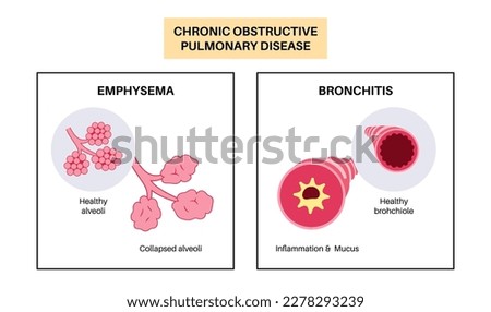 Chronic obstructive pulmonary disease or COPD. Group of lung disease. Problem with airways and air sacs, mucus in lungs, collapsed alveoli. Illness of human respiratory system flat vector illustration