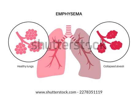 Emphysema disease concept. Damaged alveoli, failure airway. Floppy walls between air sacs in human lungs. Shortness of breath, chest tightness. Illness of respiratory system flat vector illustration Royalty-Free Stock Photo #2278351119
