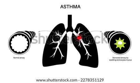 Asthma disease concept. Shortness of breath, chest tightness, causes of cough. Narrow and swell airways, extra mucus in lungs. Allergic condition, problem with respiratory system vector illustration Royalty-Free Stock Photo #2278351129