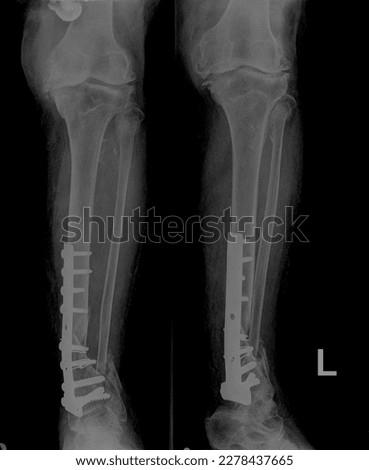 Where is the shin located?
The shinbone is the long bone that connects the ankle and knee joints. It is located on the lower leg with an average length of more than 30 cm. The shinbone is considered t