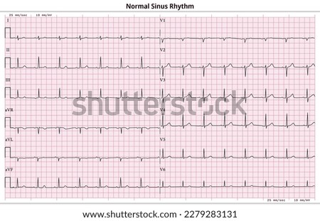 ECG Normal Sinus Rhythm - 12 Lead ECG Common Case - 6 Sec - Vector Illustration Royalty-Free Stock Photo #2279283131
