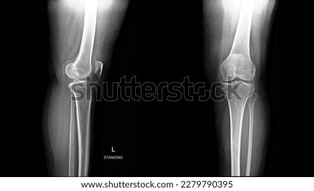 Film X-ray examination of LT knee AP and Lateral view. Old Asian woman. Anatomy of the knee. standard projection to assess the knee joint, distal femur, proximal tibia and fibula and the patella. Royalty-Free Stock Photo #2279790395