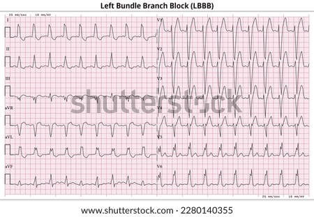 ECG LBBB (Left Bundle Branch Block) - 12 Lead ECG Common Case - 6 Sec - Vector Illustration Royalty-Free Stock Photo #2280140355