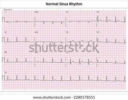 ECG Normal Sinus Rhythm - 12 Lead ECG Common Case - 3 Seclead - Vector Illustration Royalty-Free Stock Photo #2280178551