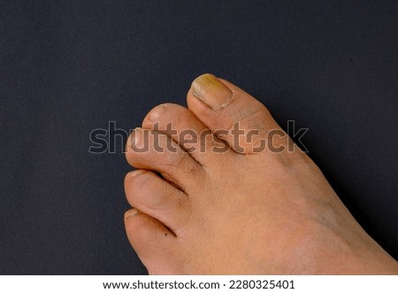 photo of foot with long thumb toe nail Royalty-Free Stock Photo #2280325401