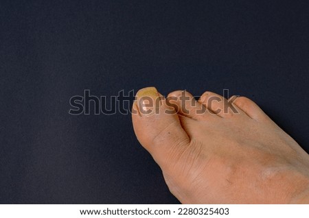 photo of foot with long thumb toe nail Royalty-Free Stock Photo #2280325403