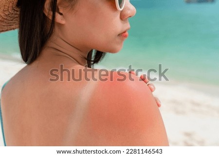 Sunburned skin on shoulder of a woman because of not using cream with sunscreen protection. Red skin sun burn after Sunbathing at the beach. Summer and holiday concept Royalty-Free Stock Photo #2281146543