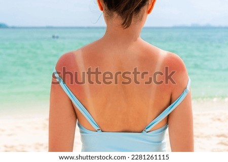 Sunburned skin on shoulder and back of a woman because of not using cream with sunscreen protection. Red skin sun burn after Sunbathing at the beach. Summer and holiday concept. Close up Royalty-Free Stock Photo #2281261115