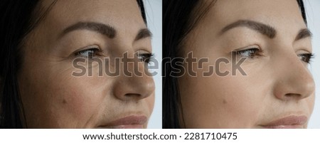 Face wrinkles before and after treatment Royalty-Free Stock Photo #2281710475