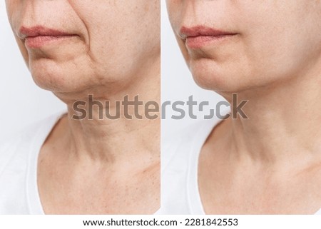 Lower part of the face and neck of elderly woman with signs of skin aging before and after facelift, plastic surgery on white background. Rejuvenation of flabby sagging skin, wrinkles, creases Royalty-Free Stock Photo #2281842553