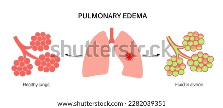 Pulmonary edema anatomical poster. Abnormal fluid in lungs. Inflammation in the human respiratory system. Alveoli with fluid. Purulent material in the chest. Shortness of breath and causes of cough Royalty-Free Stock Photo #2282039351
