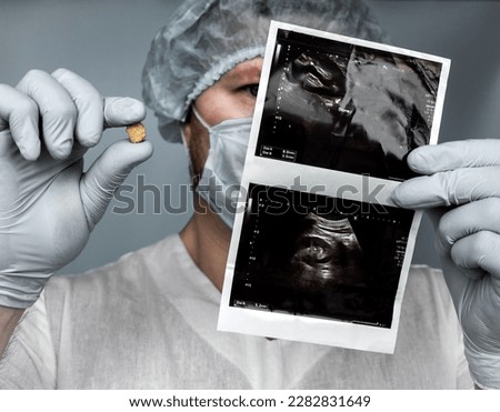 Concrement withdrawn from the kidney with an ultrasound in the doctor's hands. Human urolithiasis. Phosphate or oxalate kidney stone. Urologist surgeon demonstrates a kidney stone. Doctor in medical Royalty-Free Stock Photo #2282831649