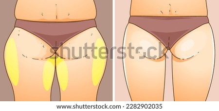 A woman's body with problem areas. Before, after. Medical infographic. Healthcare illustration. Vector illustration.  Royalty-Free Stock Photo #2282902035