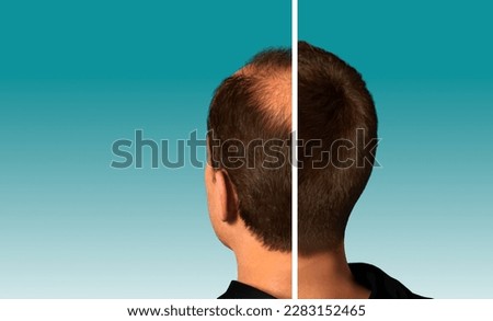 Man before after hair loss treatment. Head balding man before after hair. . Web banner or slider concept Royalty-Free Stock Photo #2283152465
