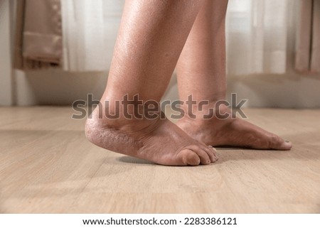 Woman's leg is edema (swelling) after cancer treatment.