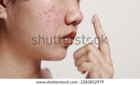 Asian teenage with acne face skin problem, Dermatological disease, white background. Royalty-Free Stock Photo #2283852979