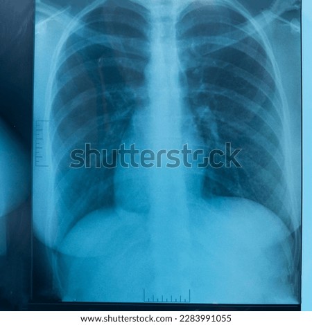 Human lung x-ray analysis, doctor examines lung disease. Pneumonia. Lung x-ray isolated on white background.