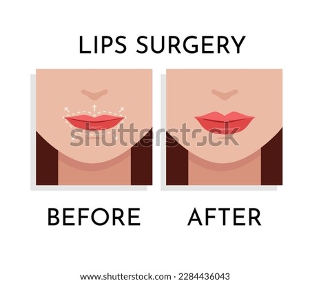 Lips Surgery correction Vector illustration. Plastic and aesthetic surgery concept. Beauty Procedure  on woman Face with dotted lines on lips and anatomical zones Up and Down flat design cartoon style Royalty-Free Stock Photo #2284436043