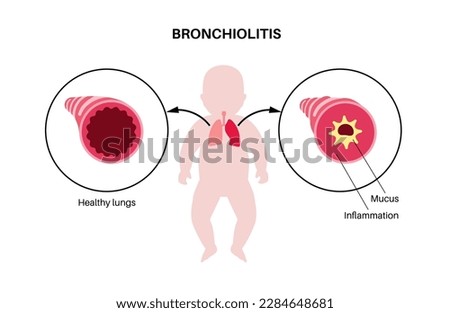 Bronchiolitis infection in young child body. Viral infection of lungs in the infant silhouette. Inflammation and mucus in the airways. Lung disease, pain in chest and cough flat vector illustration. Royalty-Free Stock Photo #2284648681