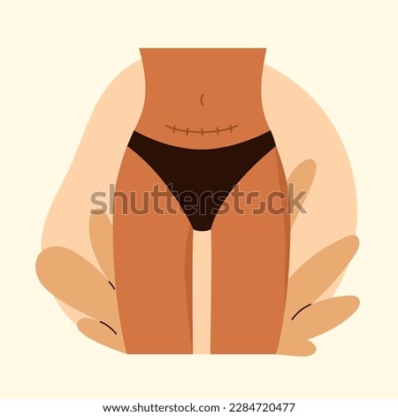 Cesarean scar. Stitches after caesarean section on female belly. C-section, surgical delivery operation concept. Vector illustration in cartoon style. Isolated white background. Royalty-Free Stock Photo #2284720477