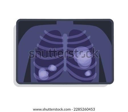 Lung Cancer Xray Image Flat Vector Illustration. Human Chest radiography with white areas. Pneumonia, pulmonary fibrosis disease, smoker tuberculosis, asthma, bronchial carcinoma concept. MRI scan Royalty-Free Stock Photo #2285260453