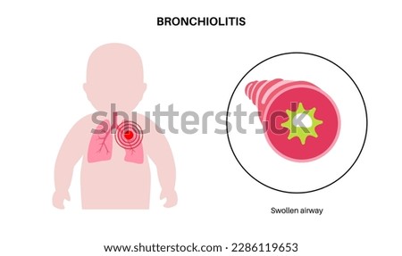 Bronchiolitis infection in young child body. Viral infection of lungs in the infant silhouette. Inflammation and mucus in the airways. Lung disease, pain in chest and cough flat vector illustration. Royalty-Free Stock Photo #2286119653