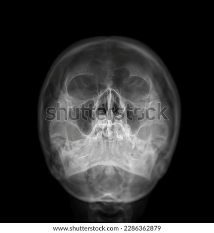 X-ray image of Human Skull   Water's view for diagnosis skull fracture  isolated on Black Background.