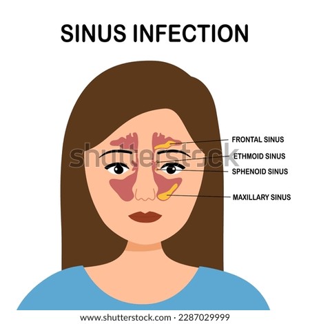 Sinusitis or sinus infection infographic in flat design on white background. Royalty-Free Stock Photo #2287029999