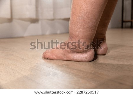 Woman's leg is edema (swelling) after cancer treatment.