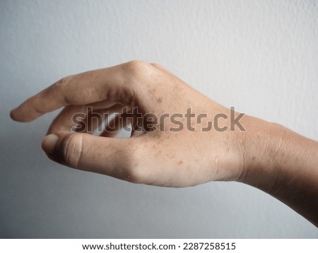 Close-up view of the dark sunspots on the fair-skinned hand that is unprotected for a long time when doing outdoor activity Royalty-Free Stock Photo #2287258515