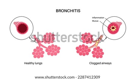Bronchitis concept, infection of the lungs. Bronchi anatomical poster. Irritated, swelling and inflamed airways. Difficult breathing, cough, chest pain and mucus in lungs flat vector illustration. Royalty-Free Stock Photo #2287412309