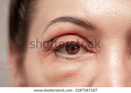 Plastic surgery of the face, skin tightening around the eyes. Surgical procedure to strengthen the skin of the eyelids, remove fatty hernias in the eyes. Operational blepharoplasty. Royalty-Free Stock Photo #2287587187