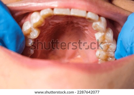 Close-up of the upper jaw, hard palate, soft palate, teeth and gums of a middle-aged woman. Royalty-Free Stock Photo #2287642077