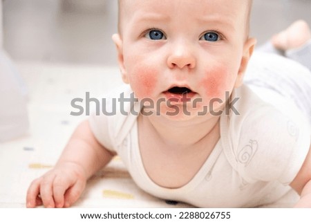 Baby face with eczema on cheeks. Atopic dermatitis. Allergy. Dry skin, rash, itch and other dermatology symptoms. Baby skin care and medical treatment. Healthcare and skin diseases. Royalty-Free Stock Photo #2288026755