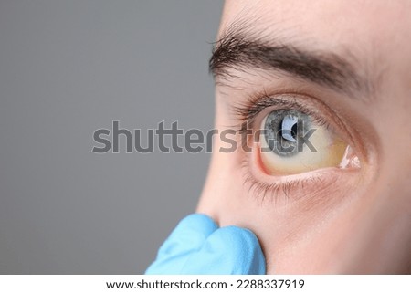 Doctor checking woman with yellow eyes on grey background, closeup. Symptom of hepatitis Royalty-Free Stock Photo #2288337919