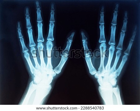 X-rayed human hand. X-ray of hand bones. Woman's hands x-rays film. Film x-ray both hand AP, doctor office. Human skeleton. Royalty-Free Stock Photo #2288540783