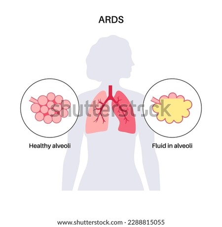 RESPIRATORY-DISTRESS-SYNDROME Stock Vector Images - Avopix.com