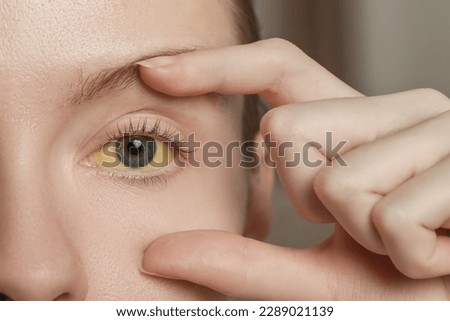 Woman with yellow eyes on blurred background, closeup. Symptom of hepatitis Royalty-Free Stock Photo #2289021139