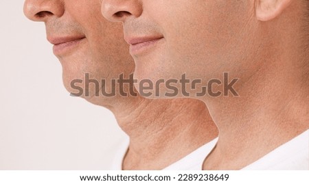 A close portrait of an aged man before and after the facial rejuvenation procedure. Correction of the chin shape liposuction of the neck. Fillers in the cheekbones and chin. The result of the Royalty-Free Stock Photo #2289238649