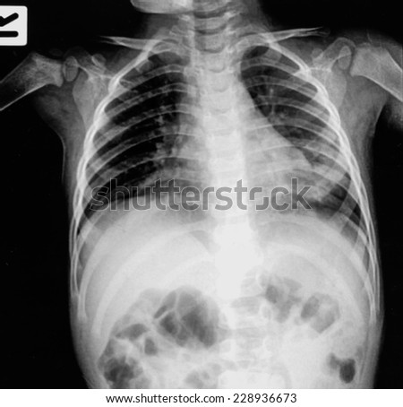 Chest x-ray.