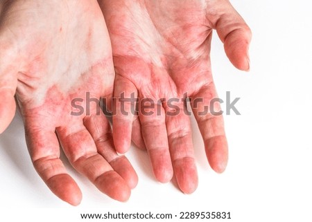 Atopic dermatitis, Highly allergic woman's hands, Red and cracked skin, Allergy problems, Health problems and autoimmune diseases, close up, white background Royalty-Free Stock Photo #2289535831