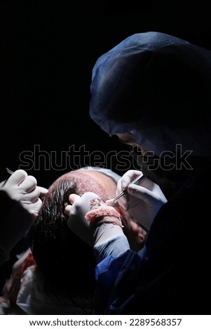 hair transplant dhi fue sapphire prp Royalty-Free Stock Photo #2289568357