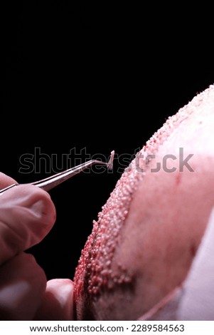 hair transplant dhi fue sapphire  Royalty-Free Stock Photo #2289584563