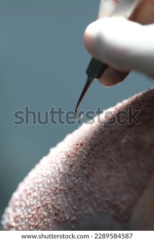 hair transplant dhi fue sapphire  Royalty-Free Stock Photo #2289584587