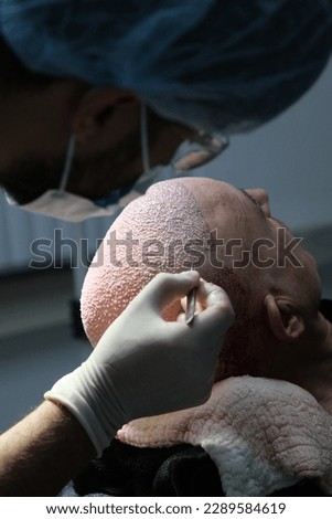 hair transplant dhi fue sapphire  Royalty-Free Stock Photo #2289584619