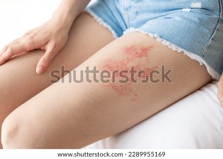 Woman with shingles on the skin she feels very painful Royalty-Free Stock Photo #2289955169