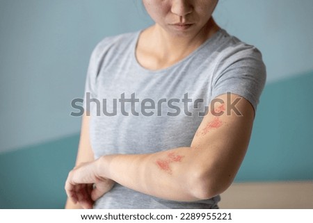 Woman with shingles on the skin she feels very painful Royalty-Free Stock Photo #2289955221