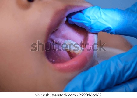 Close-up inside the oral cavity of a healthy child with beautiful rows of baby teeth. Young girl opens mouth revealing upper and lower teeth, hard palate, soft palate, dental and oral health checkup. Royalty-Free Stock Photo #2290166169